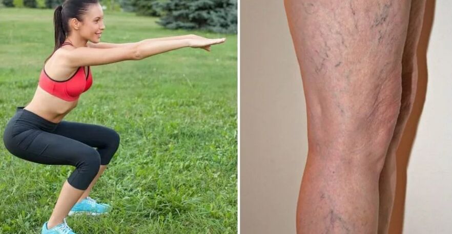 Pernas para varices