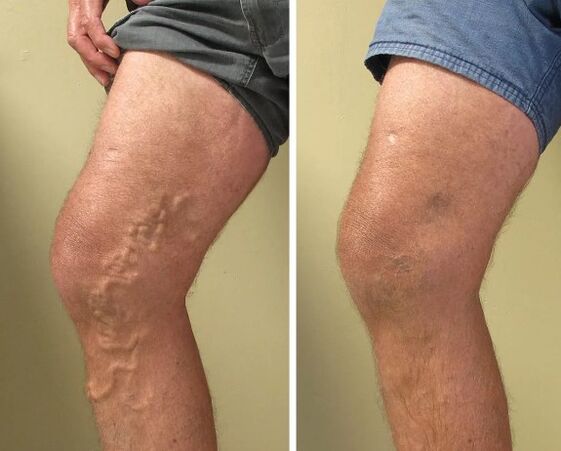 Varices vas antes e despois do tratamento